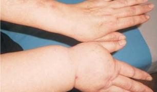 Centrul de Recuperare Esperando. Drenajul limfatic, recomandat în tratarea retenției de lichide și a altor afecțiuni