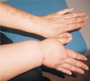 Centrul de Recuperare Esperando. Drenajul limfatic, recomandat în tratarea retenției de lichide și a altor afecțiuni